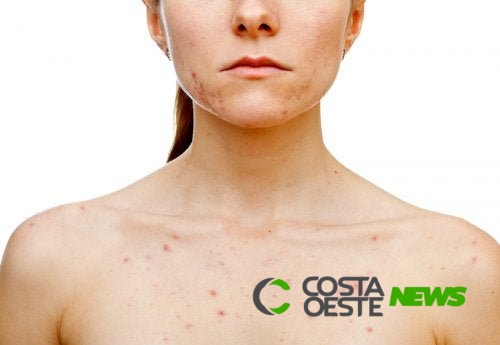 O que desencadeia acne nas mulheres?